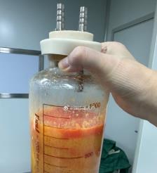沧州水动力吸脂手术要做多久？